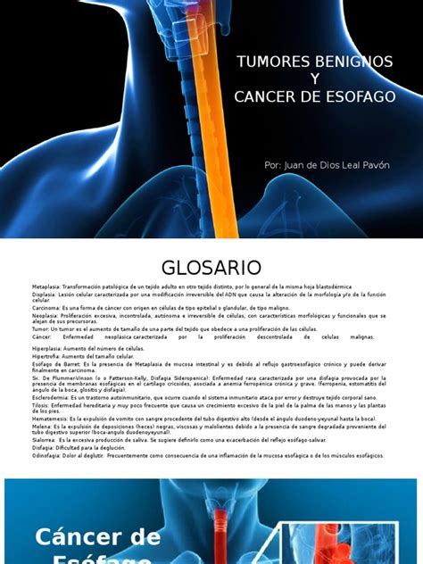 9. Cancer de Esofago