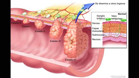 9 de cada 10 casos de cáncer de colon se curan si se ...