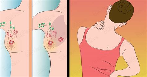 9 señales COMUNES de cáncer de mama que la mayoría de las ...