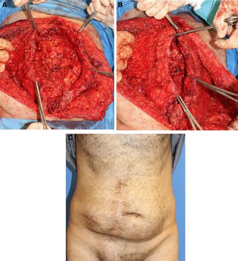 A 51 year old female with colonic cancer and abdominal ...