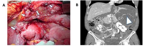 A  Abdominal peritoneal metastasis from ovarian cancer ...
