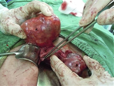 A  An extragonadal mature cystic teratoma and  B  a right ovarian ...
