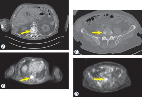 A and C. CT scan shows osteoblastic metastases in lumbar ...