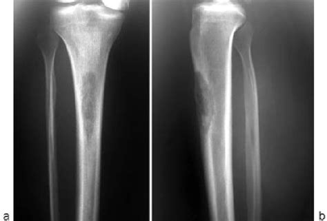 a  Anteroposterior radiograph of the proximal tibia shows ...