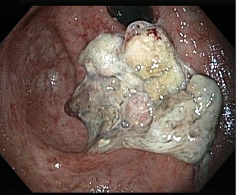 A case of colon cancer with metachronous metastasis to the ...