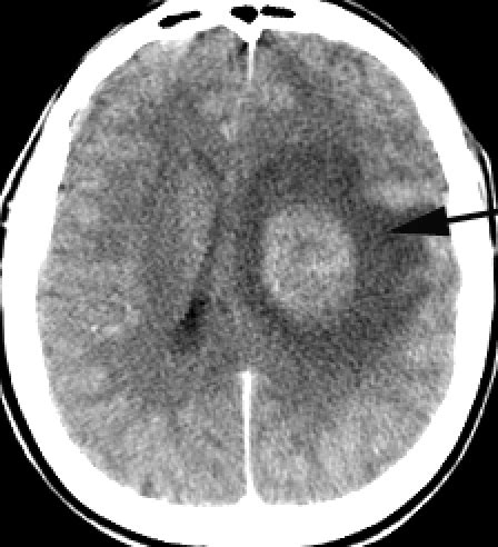 A contrast CT image of a deep frontal tumor with brain ...