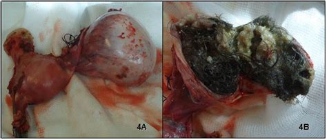 A e 4B. Teratoma cístico maduro em ovário direito, antes da abertura do ...