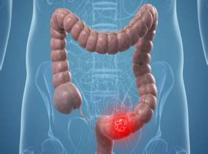A global study shows bowel cancer deaths to increase ...