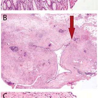 A histopathological image of primary rectal cancer and ...