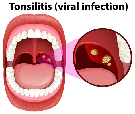 A Human Mouth Tonsillitis Infection 293529 Vector Art at ...