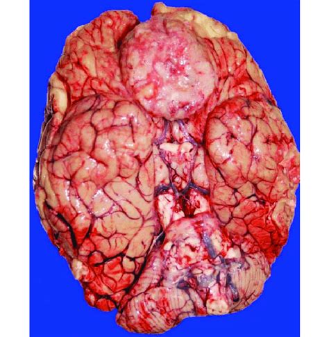 A large meningioma is seen at the base of the frontal lobe ...