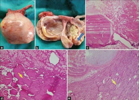 a  Mature cystic teratoma of ovary.  b  Macroscopic ph | Open i