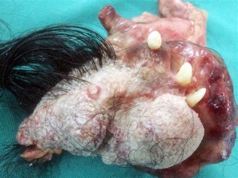 A parasite tumor with hair and teeth.... : oddlyweird