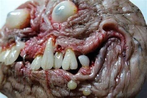 A teratoma tumor complete with teeth, eyes, and veins ...