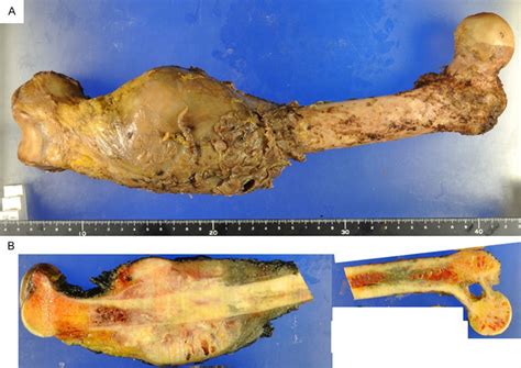 A  The resected total femur shows a mass involving the ...