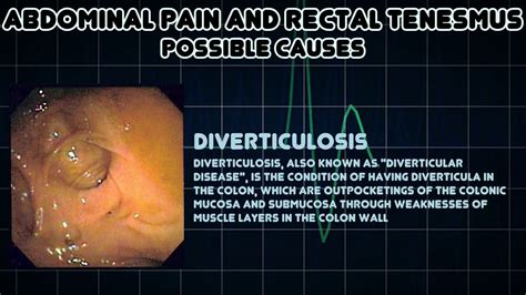Abdominal pain and Rectal tenesmus  Medical Symptom    YouTube
