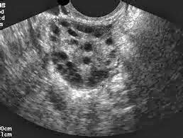 Abnormal Ovary Ultrasound | Abnormal Ovary Ultrasound ...