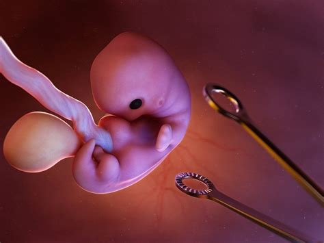 Aborto inducido: ¿en qué consiste?   Mejor con Salud