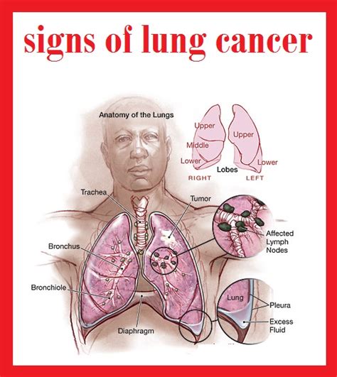 about lung cancer 3000: signs of lung cancer