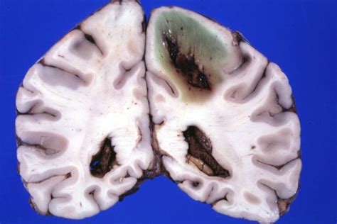 Absceso cerebral: síntomas, causas y tratamiento