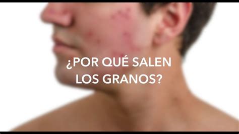 ACNÉ: RAZONES POR LAS CUALES TE SALEN GRANOS   YouTube