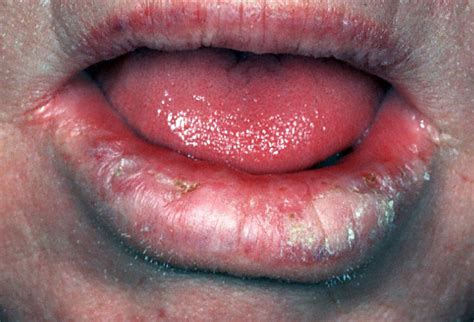 Actinic Keratosis / Lip Cancer  Hardin MD Super Site Sample