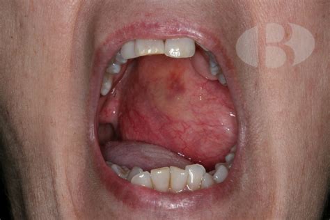 Adenoma pleomorfo » Clínica Dental Borrás