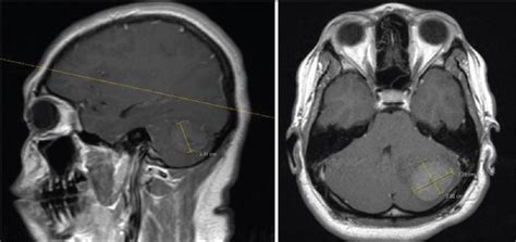 Adult hemispheric cerebellar medulloblastoma   Surgical ...
