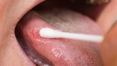 Aftas bucales: remedios caseros y cómo curar las llagas en la boca