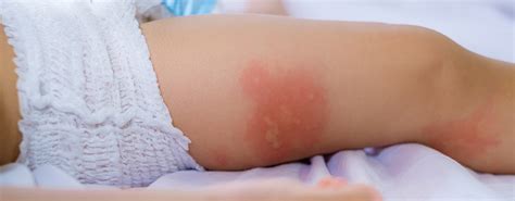 Alergia a las picaduras de insectos en niños   Alergias e ...