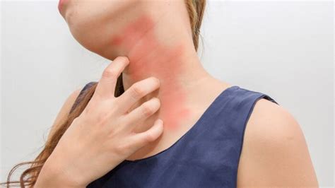 Alergia a los sulfitos, ¿qué son y qué síntomas provocan?