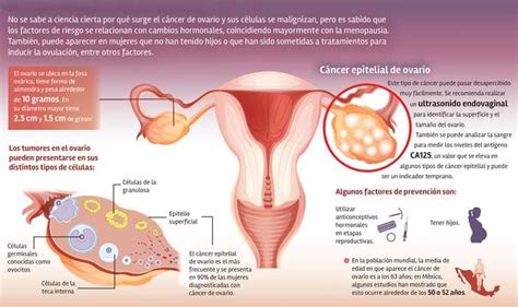 Alta mortalidad por cáncer de ovario: UNAM | Descubre ...