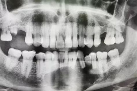 Ameloblastoma, el tumor en la mandíbula de un hombre que ...