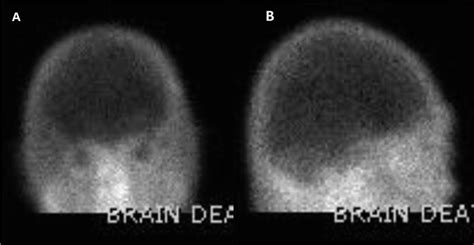 Ancillary Imaging Tests for Confirmation of Brain Death ...