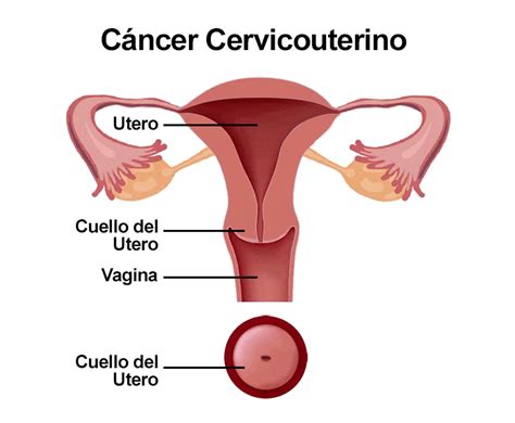 Animación de la evolución del cáncer cervicouterino