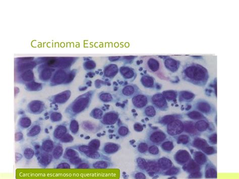 Anomalia celular en citologia cervico vaginal