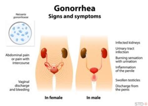 Antibiotic Resistant Gonorrhea May Be Our Next Major ...