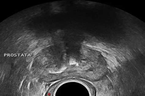 Aplicaciones del ultrasonido transrectal en cáncer de próstata