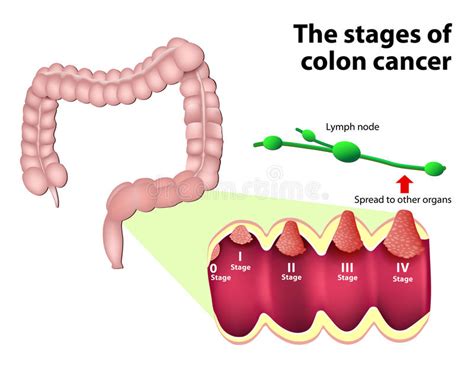 As Fases Do Câncer Colorectal Ilustração do Vetor ...