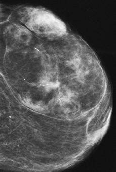Aspectos radiológicos de los hamartomas de la mama. | Revista de ...