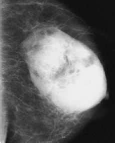 Aspectos radiológicos de los hamartomas de la mama. | Revista de ...
