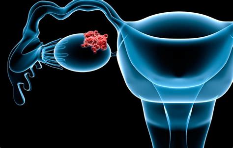 AstraZeneca, NCCN collaborate for ovarian cancer treatment
