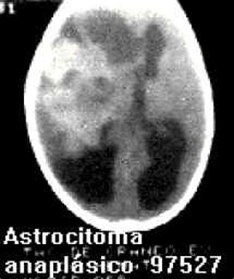 Astrocitoma Anaplásico y Glioblastoma Multiforme.