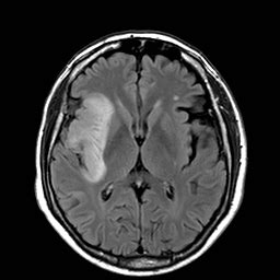 Astrocitomas   Neurocirugía Barcelona