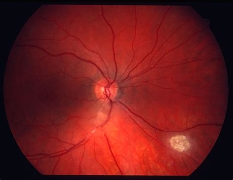 Astrocytic hamartoma of the retina   Retina Image Bank