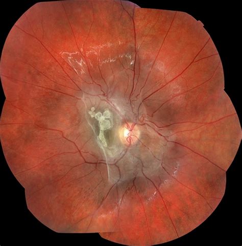 Astrocytic Hamartoma   Retina Image Bank