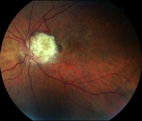 Astrocytic Hamartoma   Retina Image Bank