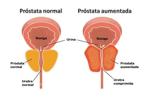 Aumento de Próstata: entenda o que é Hiperplasia Prostática Benigna ...