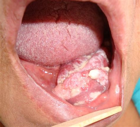 Auto exame bucal: Faça. Câncer de boca pode ser curado se ...