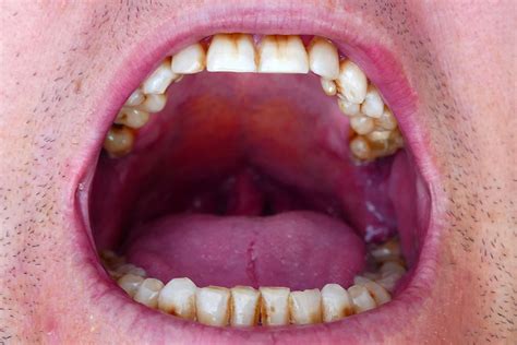 Autoexploración de boca, prevención del cáncer oral